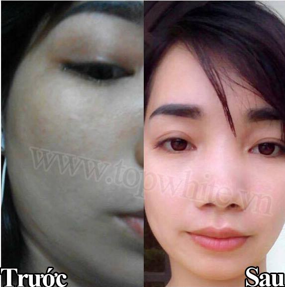 TOP WHITE ACNE FOAM CLEANSER WHITE PERFECT D5