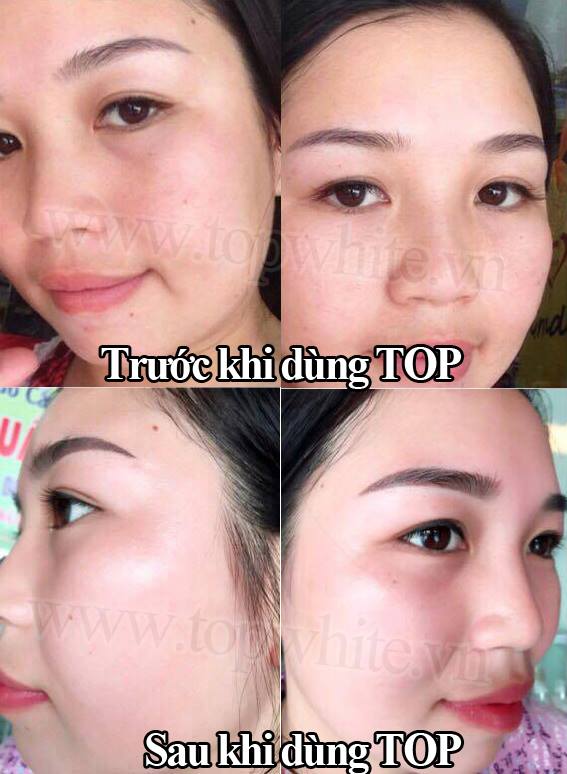 TOP WHITE ACNE FOAM CLEANSER WHITE PERFECT D5