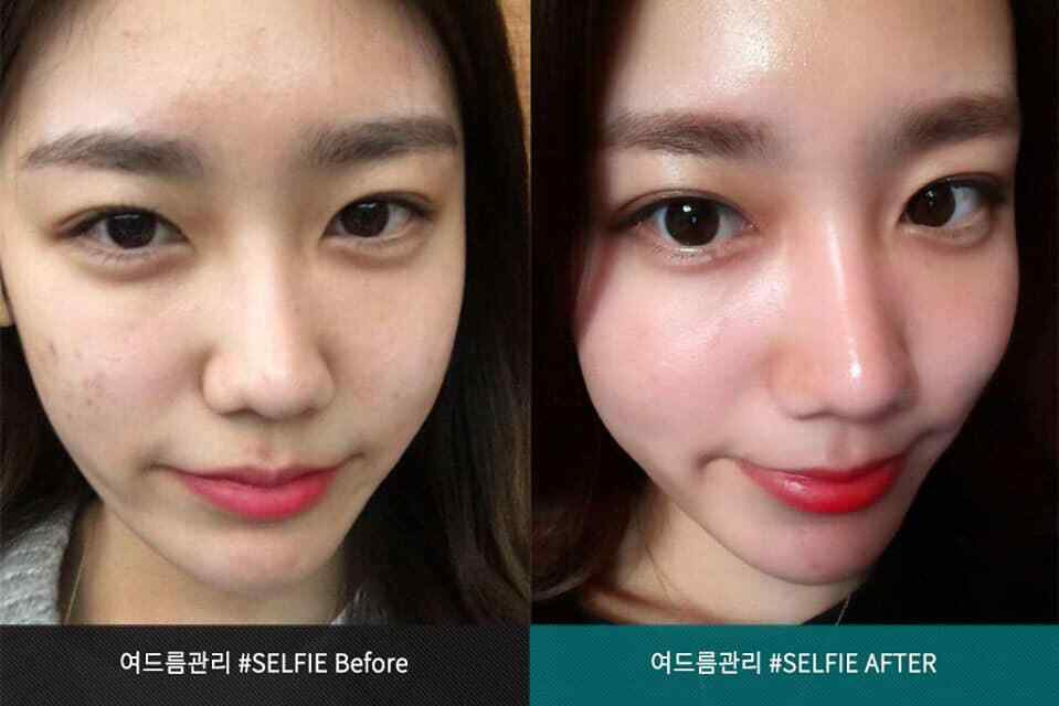 Mioskin Plus Stem Cell Frozen Mist 100 ml