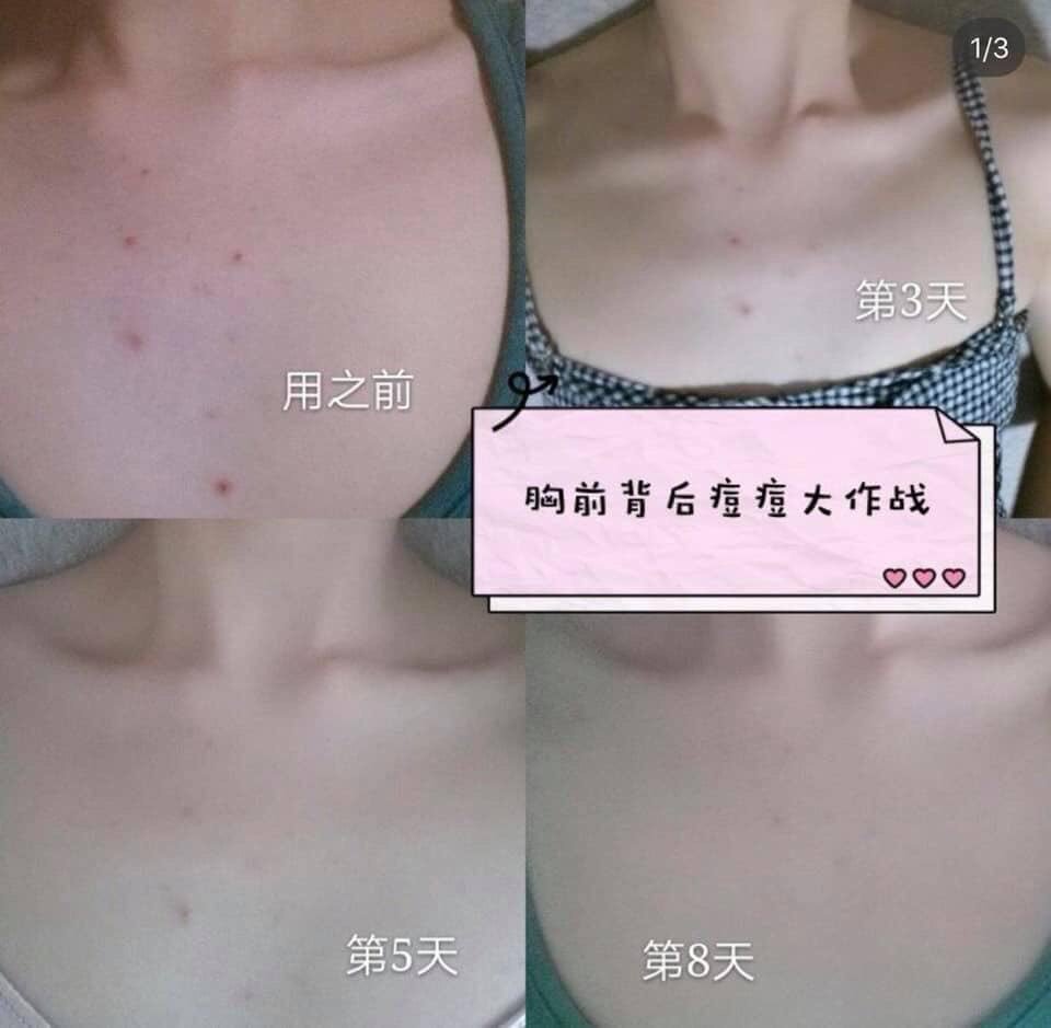 kobayashi Be Cura Acne Care Body Mist 100ml Japan