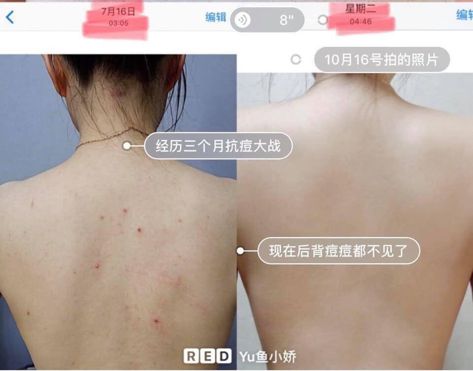 kobayashi Be Cura Acne Care Body Mist 100ml Japan