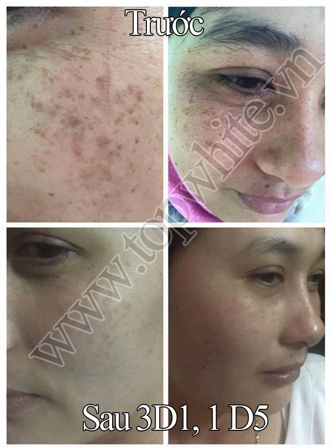 TOP WHITE WHITE PERFECT D1: RECONDITION, PIGMENTATIONS, AGE SPOTS, FRECKLES CREAM