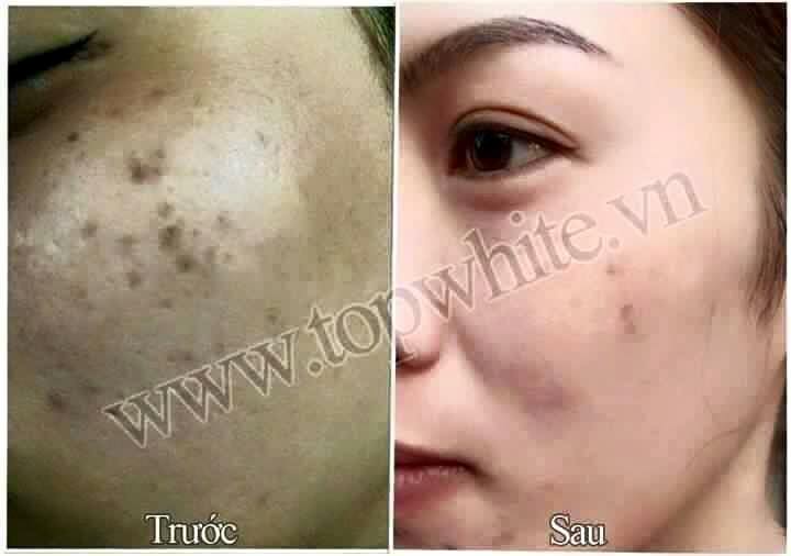 TOP WHITE WHITE PERFECT D1: RECONDITION, PIGMENTATIONS, AGE SPOTS, FRECKLES CREAM