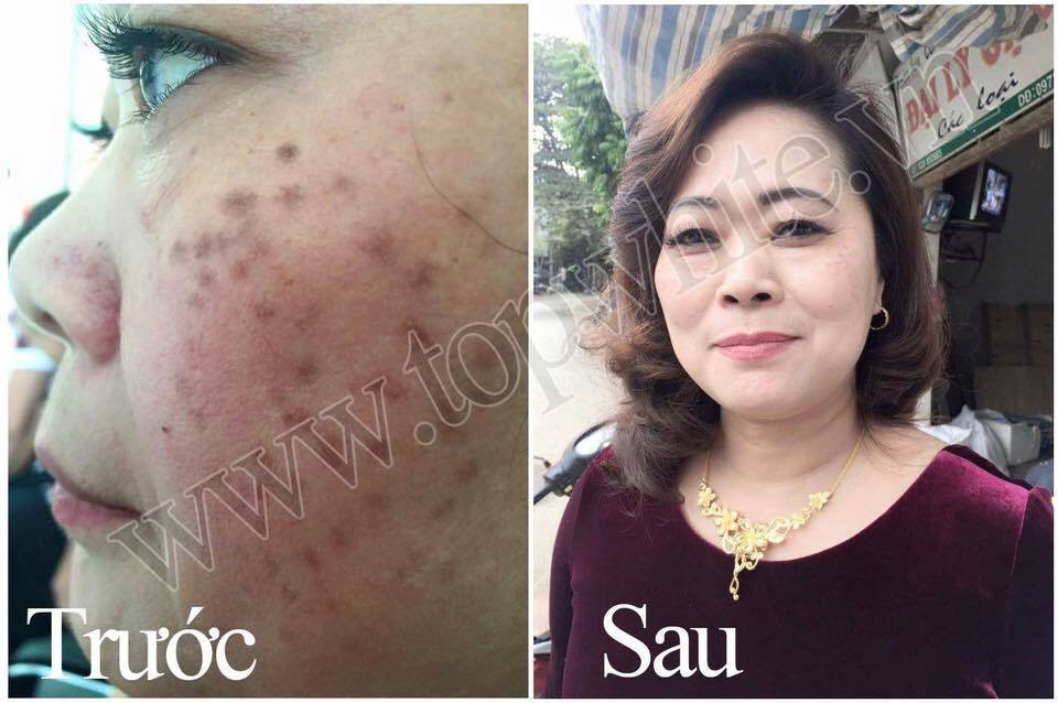 TOP WHITE WHITE PERFECT D1: RECONDITION, PIGMENTATIONS, AGE SPOTS, FRECKLES CREAM