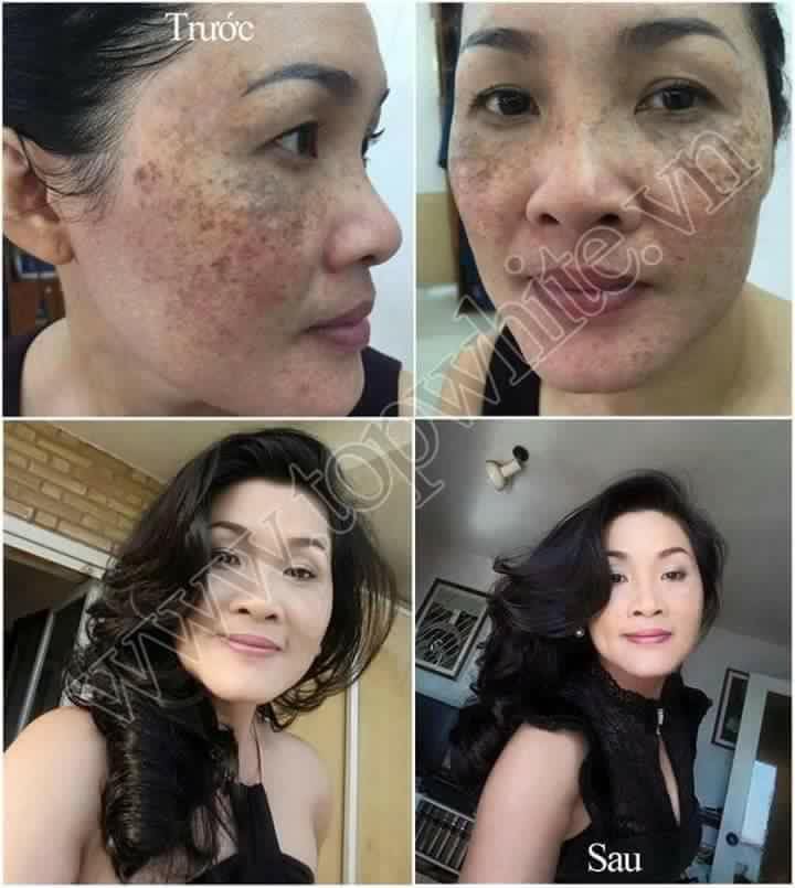 TOP WHITE WHITE PERFECT D1: RECONDITION, PIGMENTATIONS, AGE SPOTS, FRECKLES CREAM