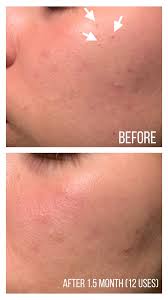 The Ordinary AHA 30% + BHA 2% Exfoliating Peeling Solution 30 ml