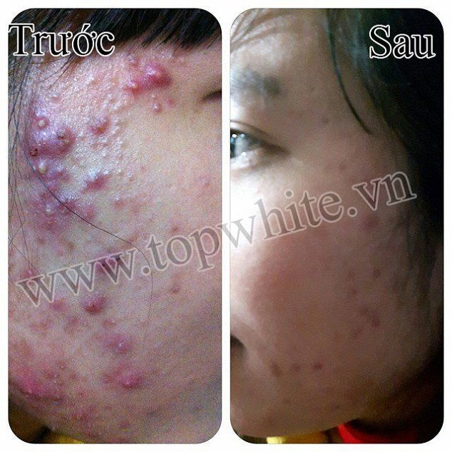 Top White White Perfect D4 Prevent Acne Serum Essence Acne Serum