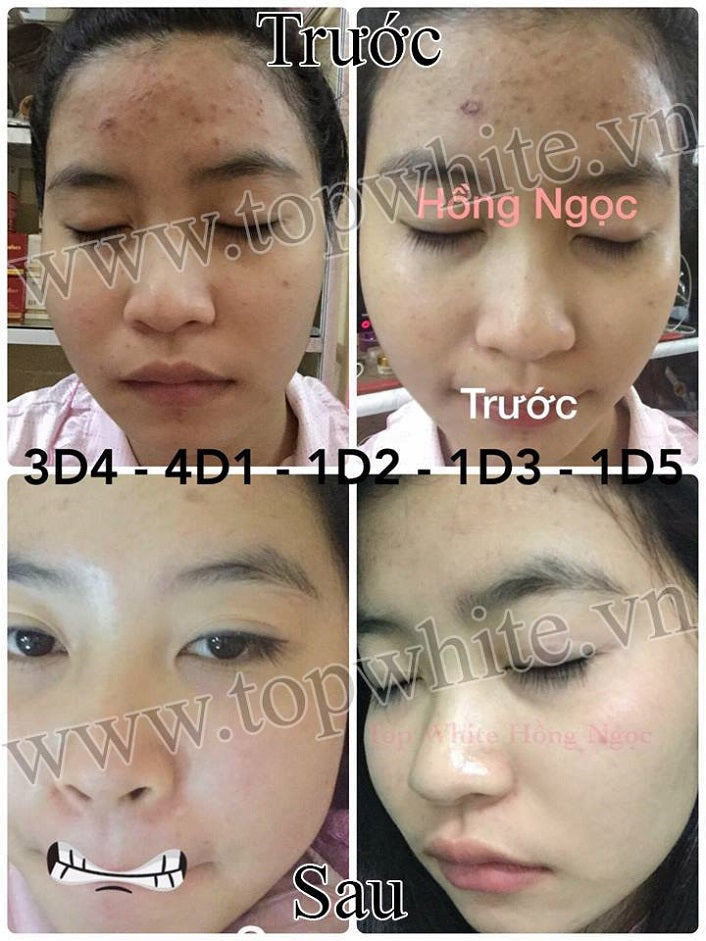 Top White White Perfect D4 Prevent Acne Serum Essence Acne Serum