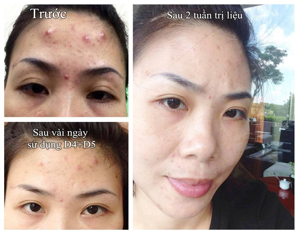 Top White White Perfect D4 Prevent Acne Serum Essence Acne Serum
