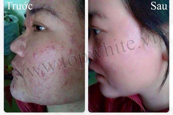 TOP WHITE PRODUCT SET FOR CLEANING SKIN, PREVENTING BLEMISHES, DARK SPOTS