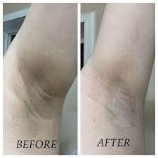 XXVIRGIN Skin Treatment Premium Cream Dark Skin Underarms, Nipple 5 ml