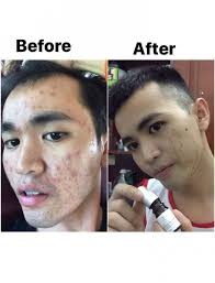 Moc Tuyet Serum 5ml Anti Aging, Reduce Acne, Reduces Dark Spots, Regenerate The Skin