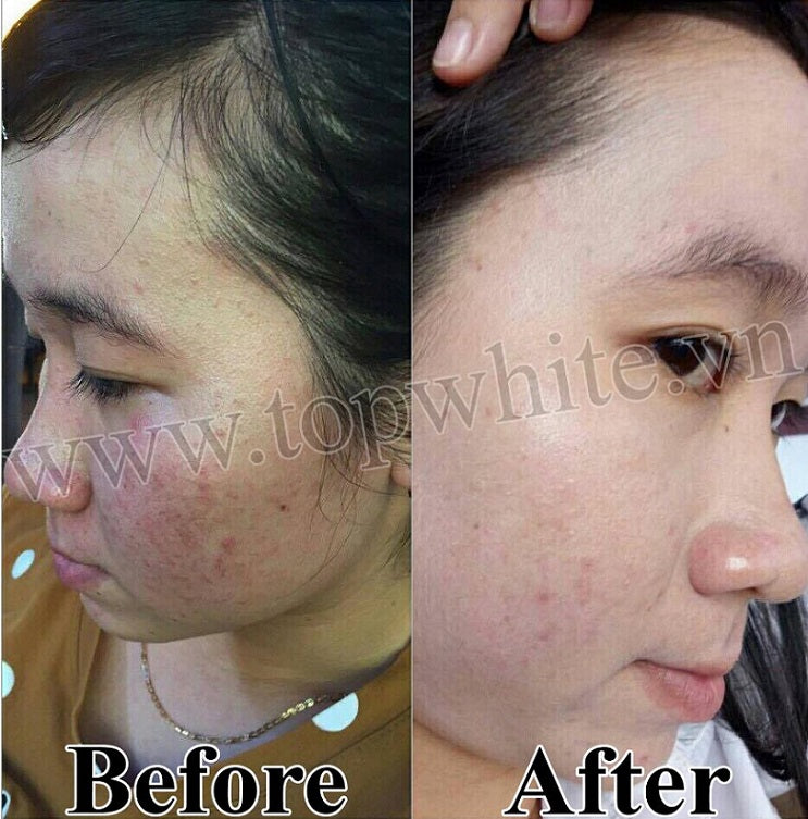 TOP WHITE PRODUCT SET FOR CLEANING SKIN, PREVENTING BLEMISHES, DARK SPOTS