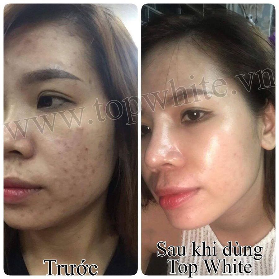 TOP WHITE PRODUCT SET FOR CLEANING SKIN, PREVENTING BLEMISHES, DARK SPOTS