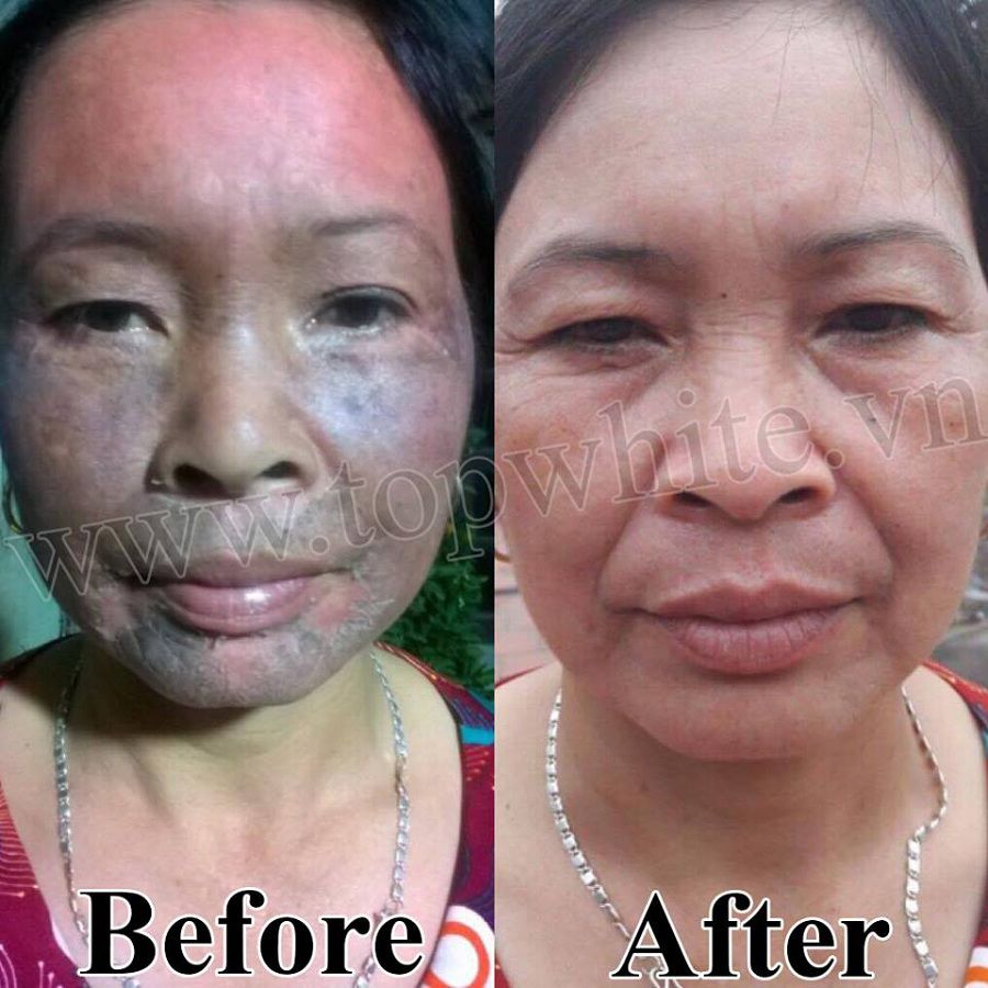 Top White product set whitens skin, prevents melasma, freckles, age spots