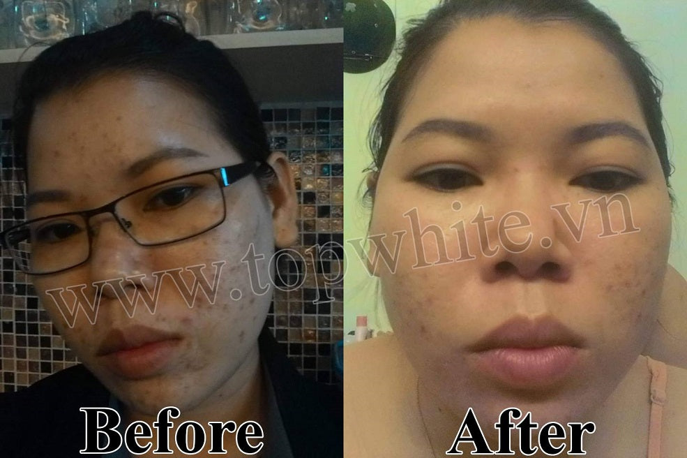 TOP WHITE PRODUCT SET FOR CLEANING SKIN, PREVENTING BLEMISHES, DARK SPOTS
